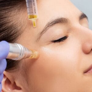 Microneedling Schulung