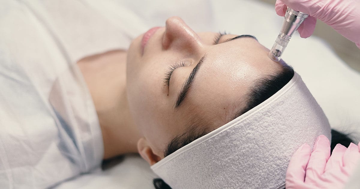 Was ist Microneedling?